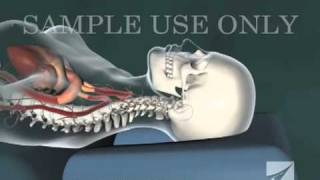 Cervical Chiropractic Adjustment [upl. by Accisej]