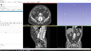 3D Slicer Tutorial 2 Manual segmentation Thresholding [upl. by Suchta]